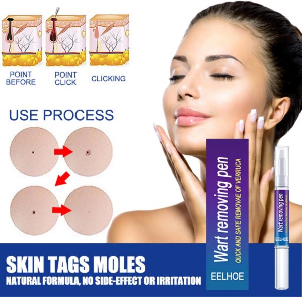 Wart Removing Pen (১টি)